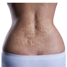Surgical treatment and reconstruction for burn injuries