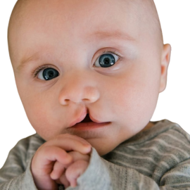 Successful cleft lip and palate repair result
