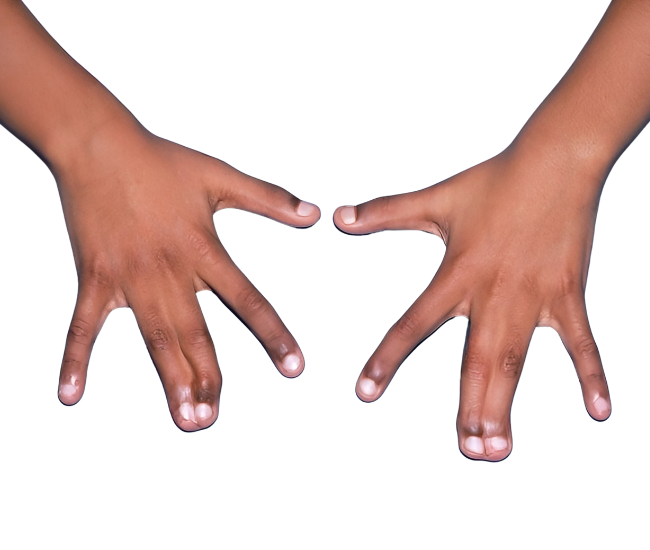 Surgical correction of webbed fingers