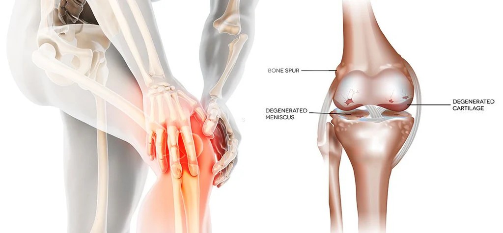 When arthritis Reconstruction Becomes Necessary