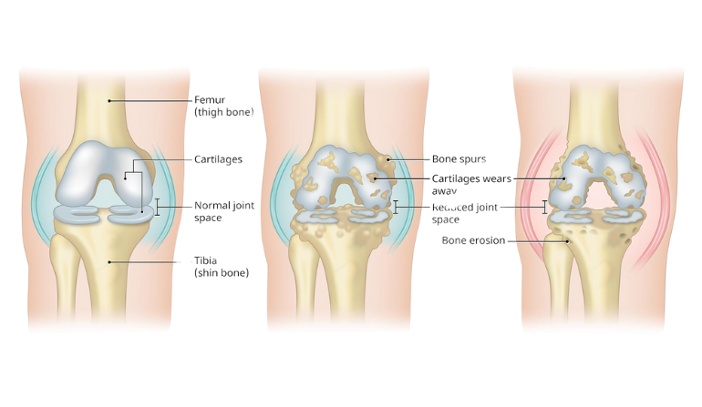 Arthritis Reconstruction
