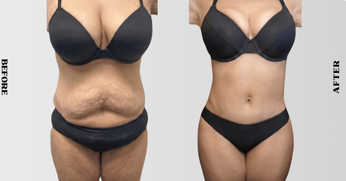 Benefits of Mommy Makeover Surgery