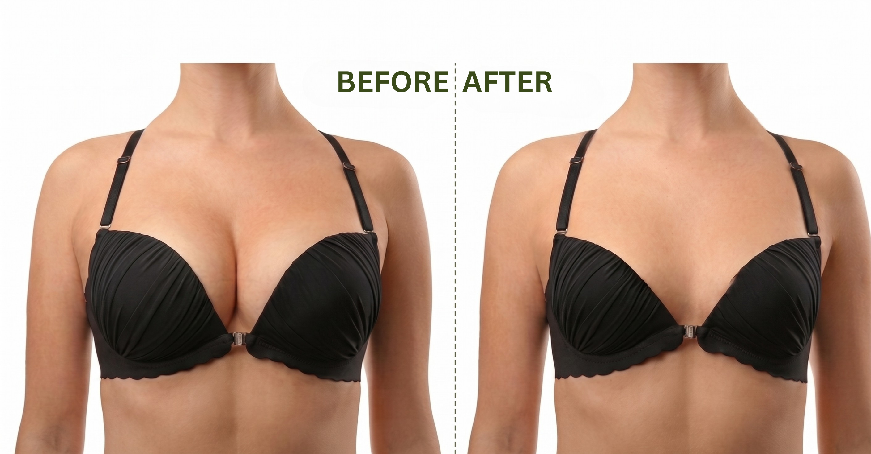 Breast Reduction Surgery