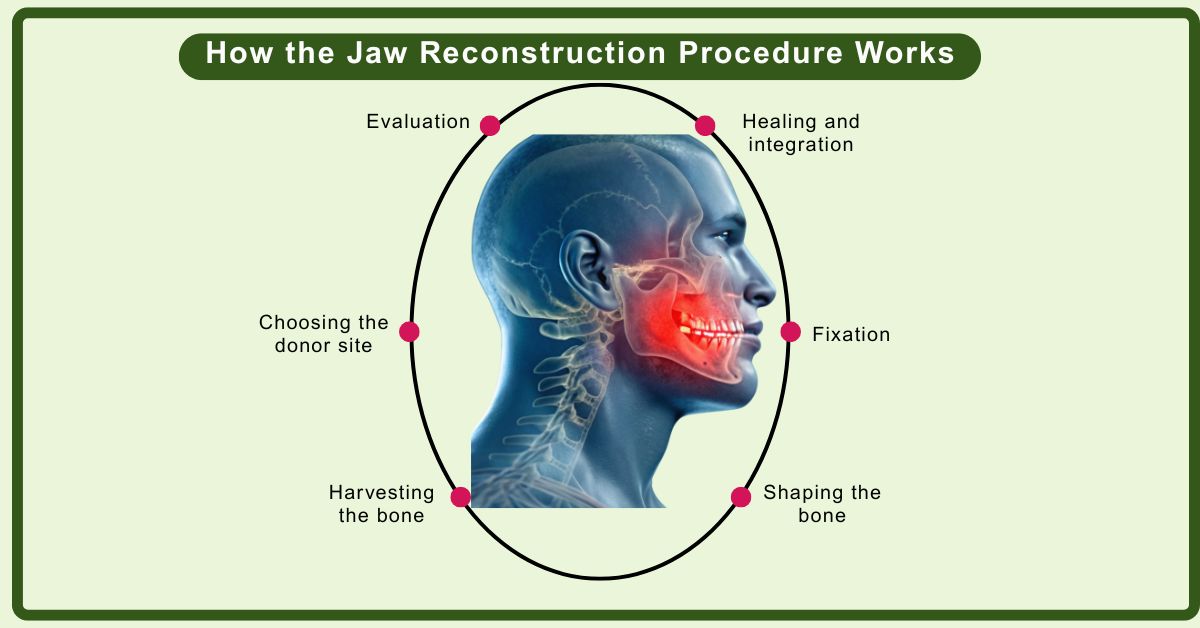 How the Jaw Reconstruction Procedure Works
