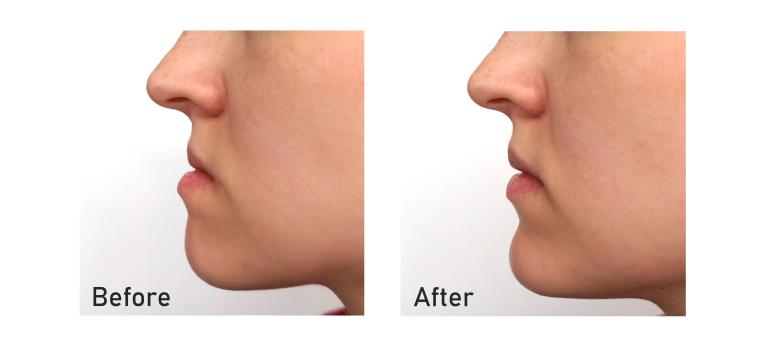 Jawbone Reconstruction Before After