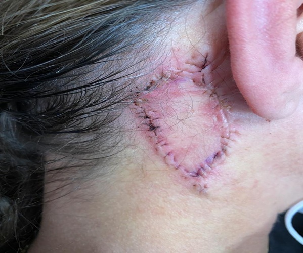Skin Grafting