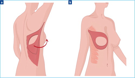 breast reconstructions