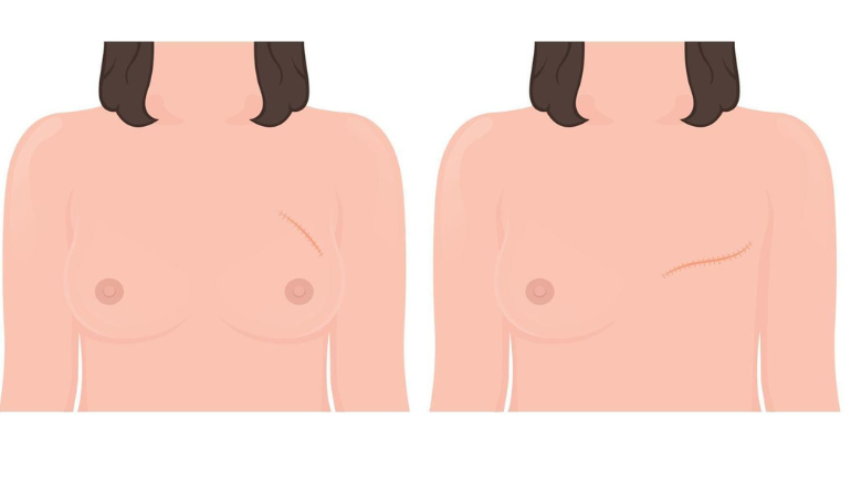 Breast Reduction (Reduction Mammoplasty)