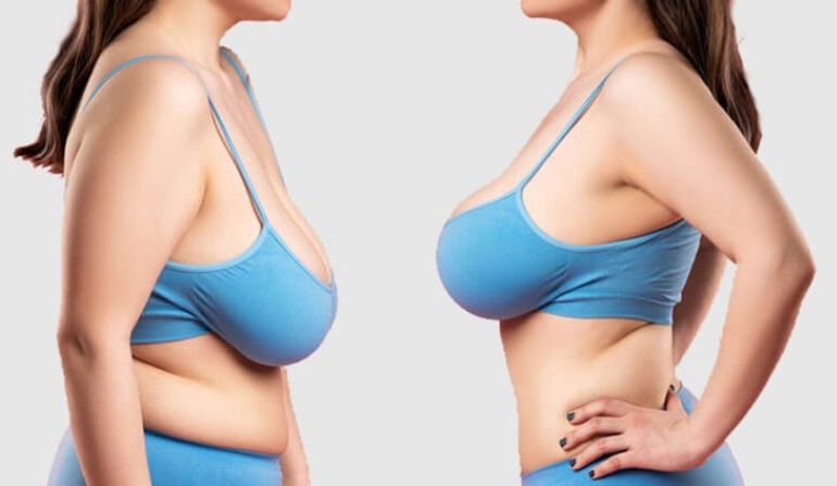 Breast Reduction Surgery