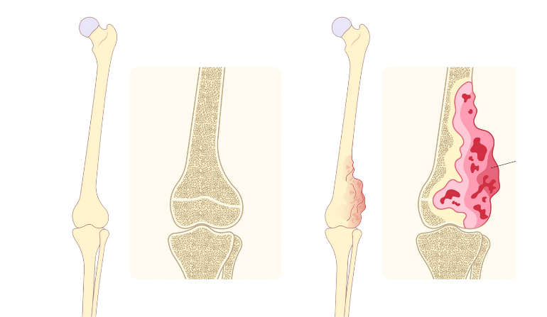 Cancer-Related Reconstruction (Skin, Bone & Soft Tissue)