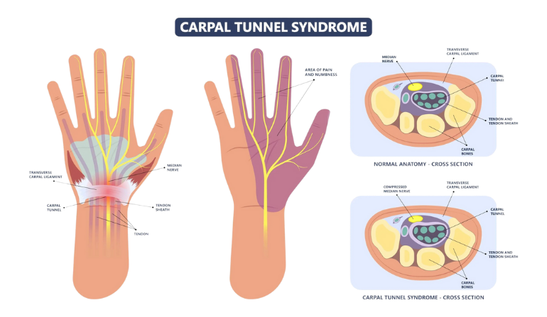 Carpal Tunnel Syndrome Repair