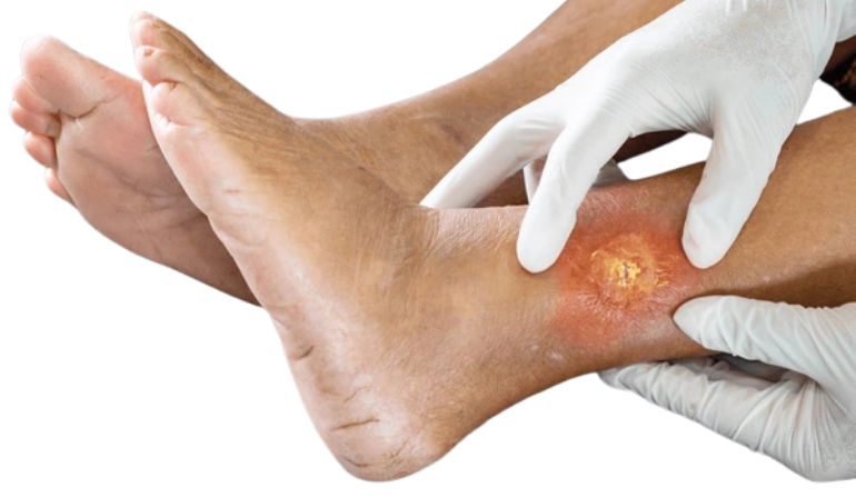 Chronic Wound Treatment