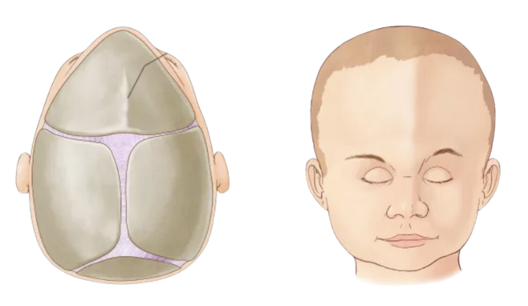 Craniosynostosis Surgery