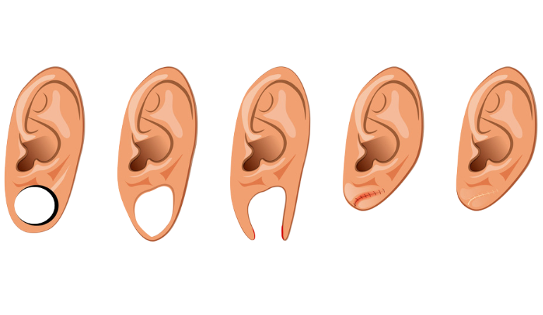 Ear Reconstruction Surgery in Mumbai by Dr. Vinay Jacob