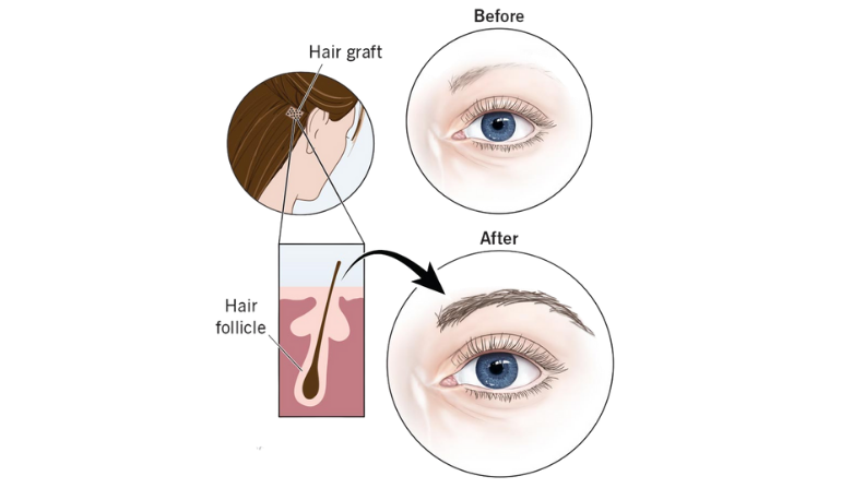 Eyebrow Transplant Surgery in Mumbai by Dr. Vinay Jacob at the Reconstructive Surgeons