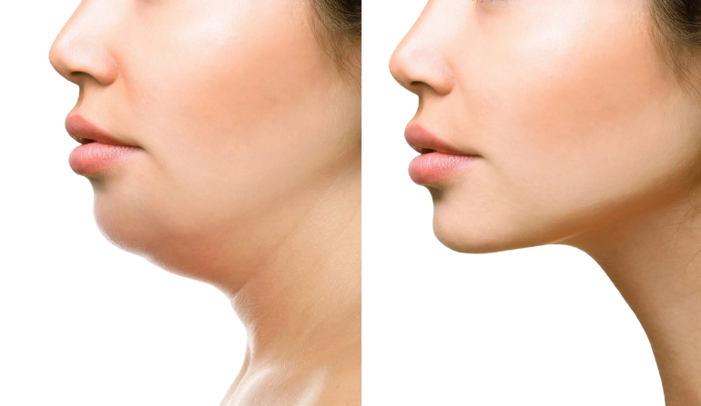 Facial Reconstruction