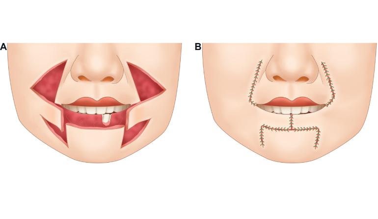 Flap Reconstruction Techniques