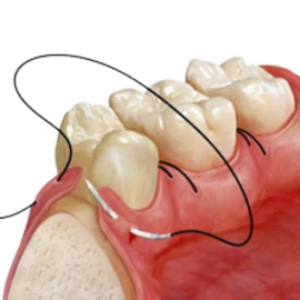 Complex flap surgery procedure for cancer reconstruction