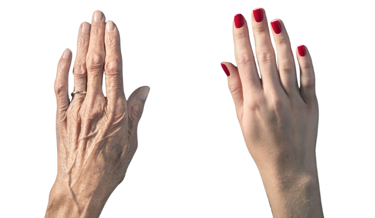Hand Rejuvenation