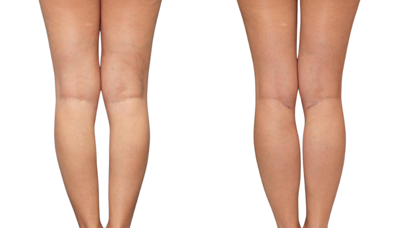 Limb Reconstruction
