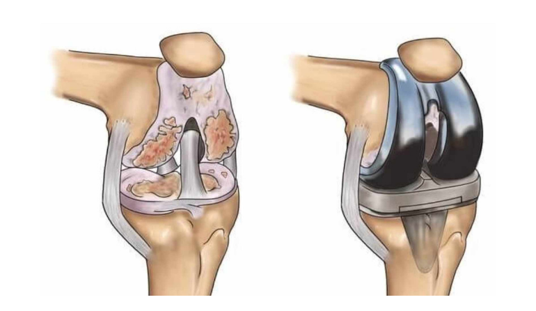 Limb Salvage Surgery