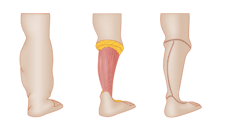 Lymphedema Surgery
