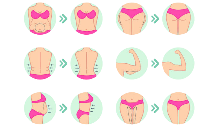 Mega Liposuction