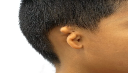microtia ear reconstruction