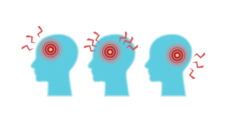 Migraine Surgery