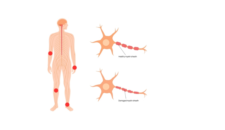Nerve Injuries