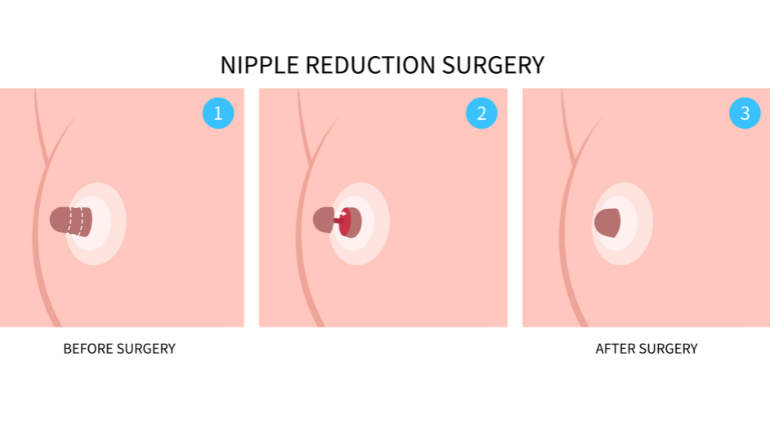 Nipple and Areola Reconstruction