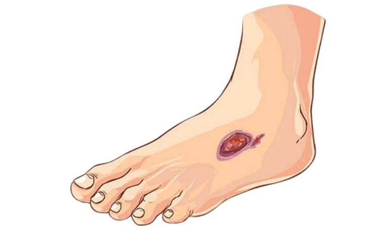 Non-Healing Wound Treatment