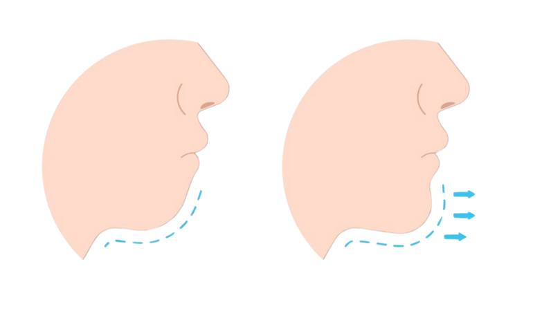 Orthognathic Surgery