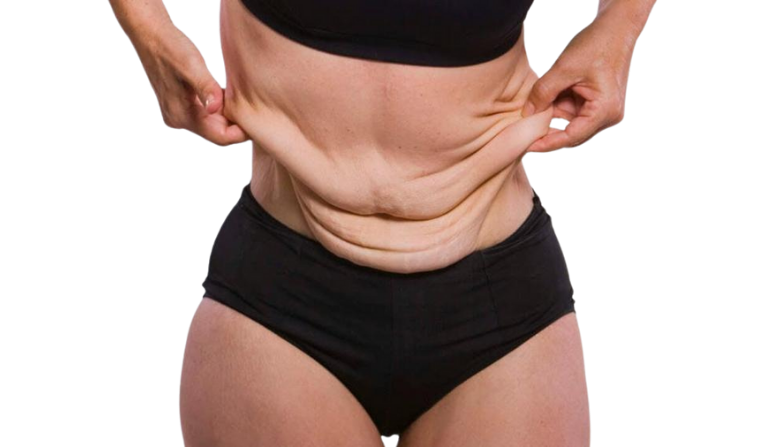 Panniculectomy Body Contouring
