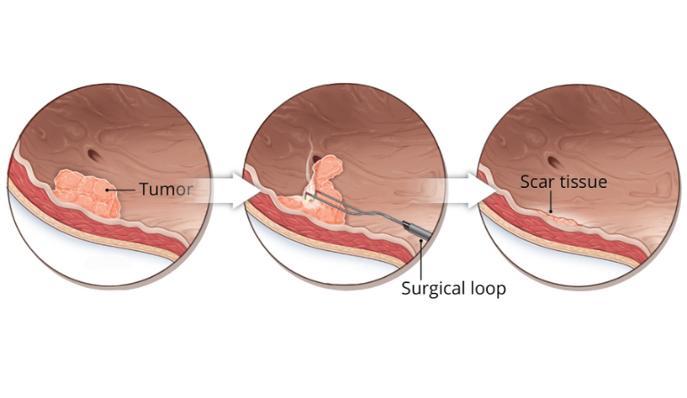 Post-Tumor Resection Reconstruction