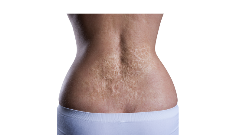 Scar and Burn Reconstruction