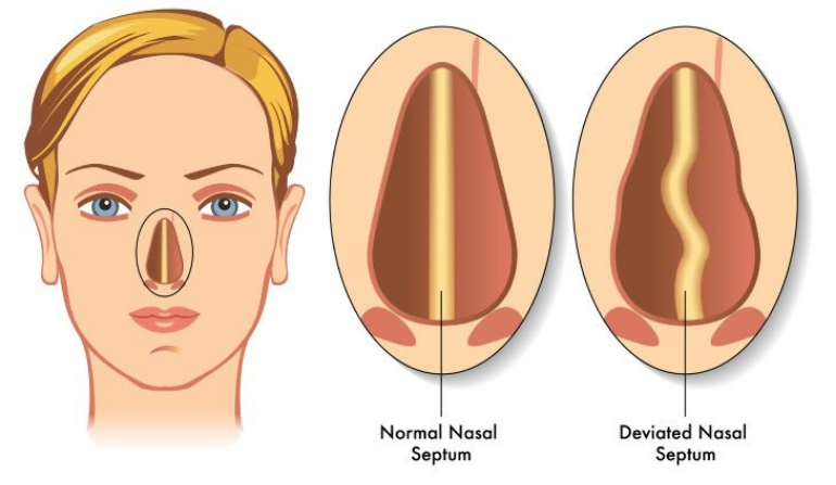 Septoplasty & Deviated Septum Correction