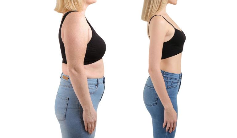 Body Lift Surgery after Massive Weight Loss in Mumbai by Dr. Vinay Jacob at the Reconstructive Surgeons