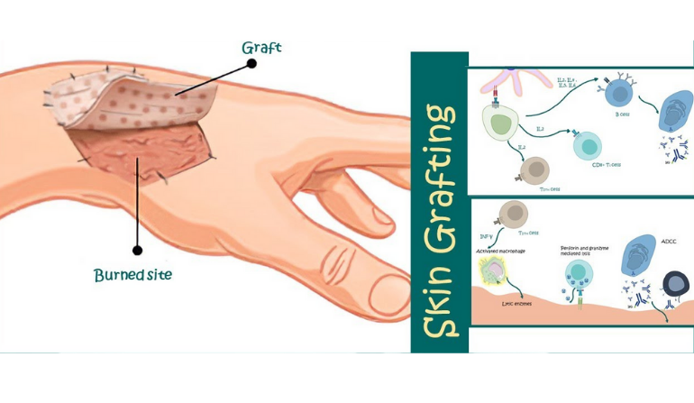 Skin Graft