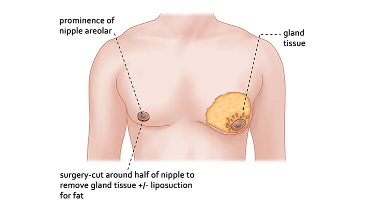 Surgical Gynecomastia Treatment Options in 2026