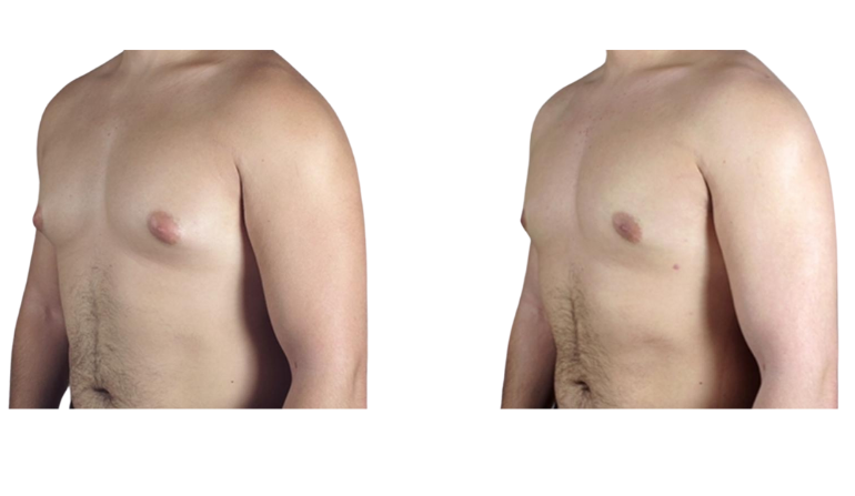 Transmasculine Procedures